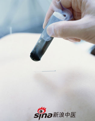 點擊將在新窗口查看全圖 反復(fù)咳嗽 試試中醫(yī)特色療法